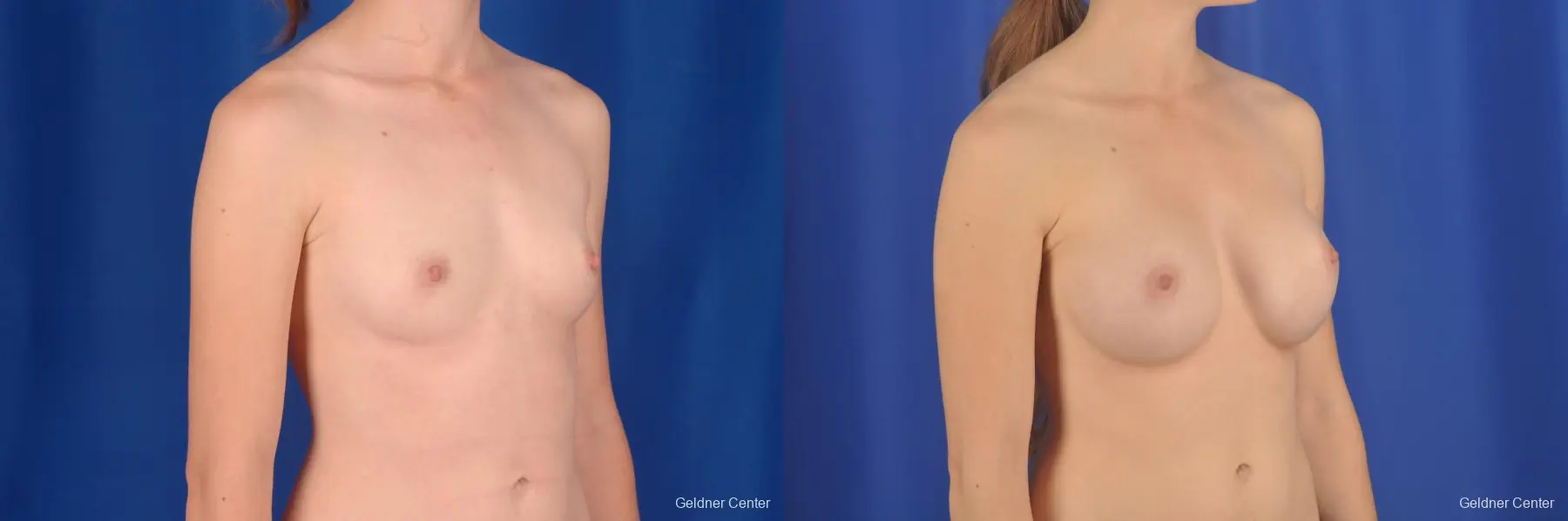 Chicago Breast Augmentation 2304 - Before and After 3