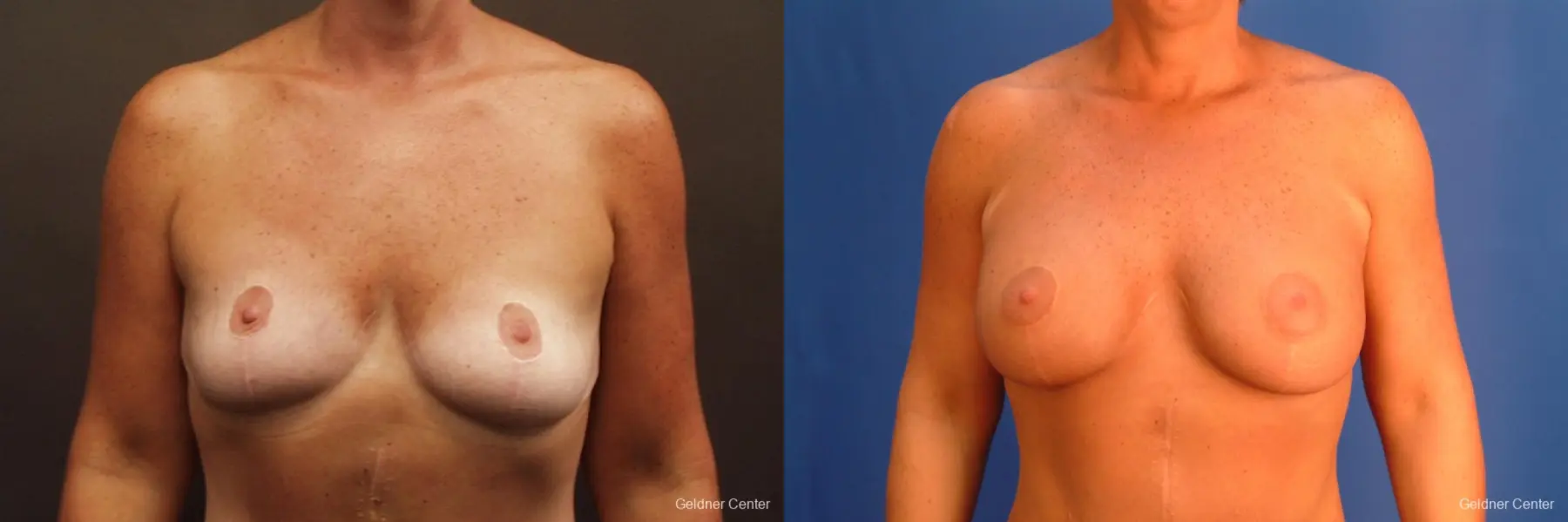 Chicago Breast Augmentation 2524 - Before and After 1