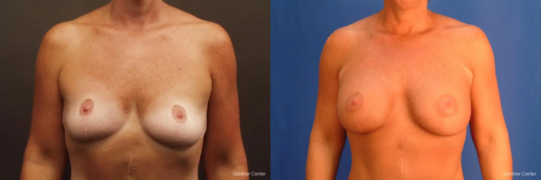 Chicago Breast Augmentation 2524 - Before and After