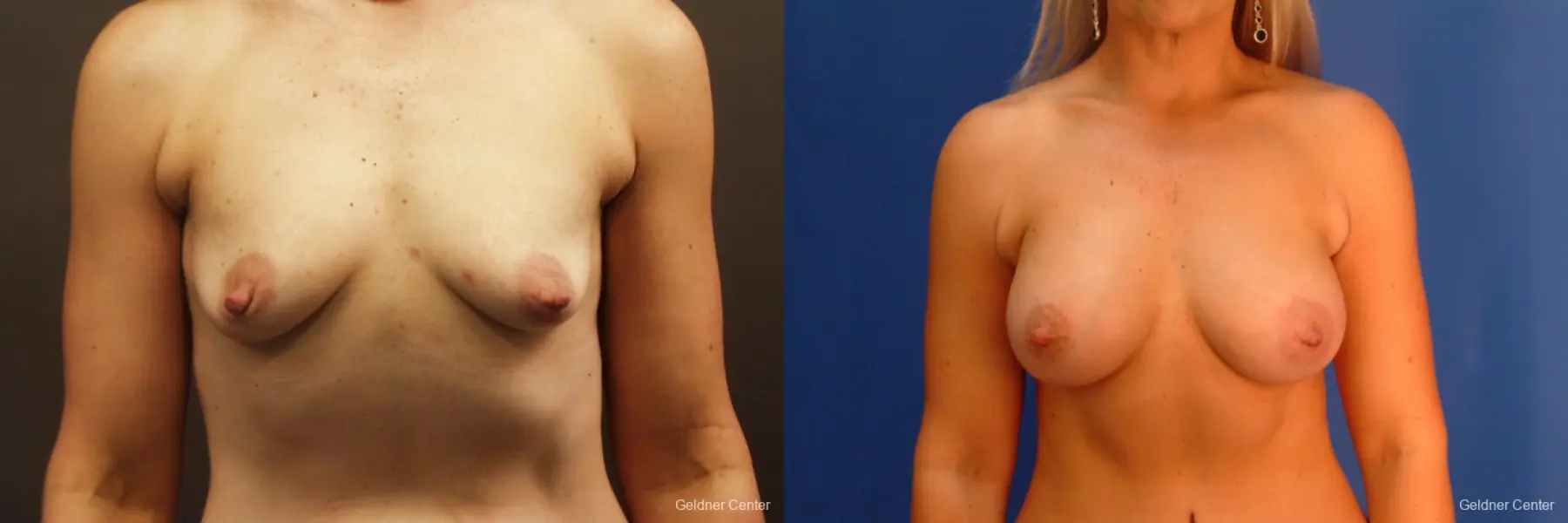 Breast Augmentation Hinsdale, Chicago 2632 - Before and After 1
