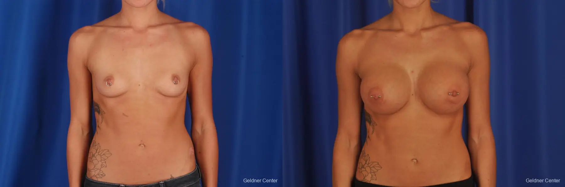 Chicago Breast Augmentation 2328 - Before and After 1