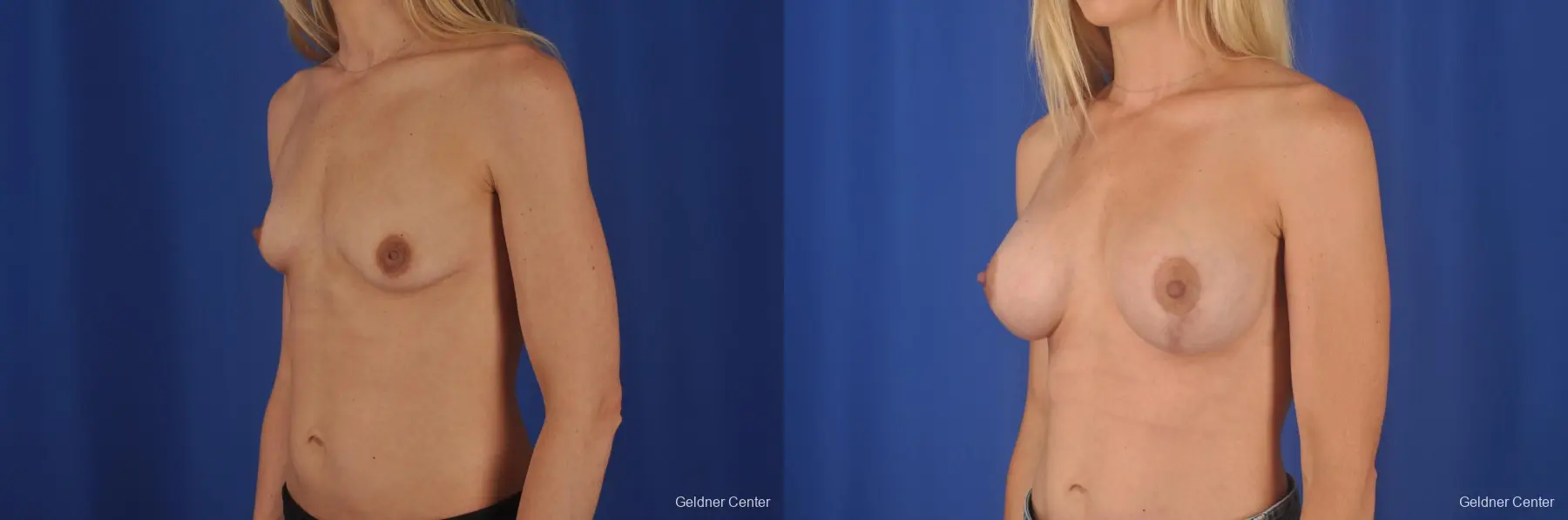 Chicago Breast Augmentation 6653 - Before and After 4