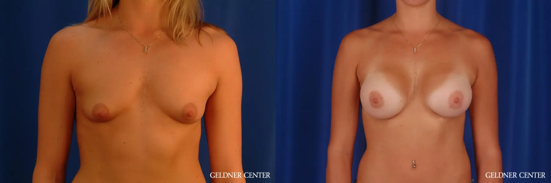 Breast Augmentation: Patient 173 - Before and After 1