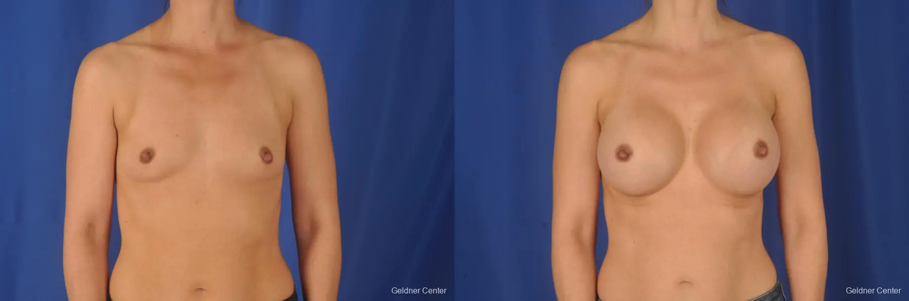 Biplanar Subpectoral Augmentation 500cc - Before and After