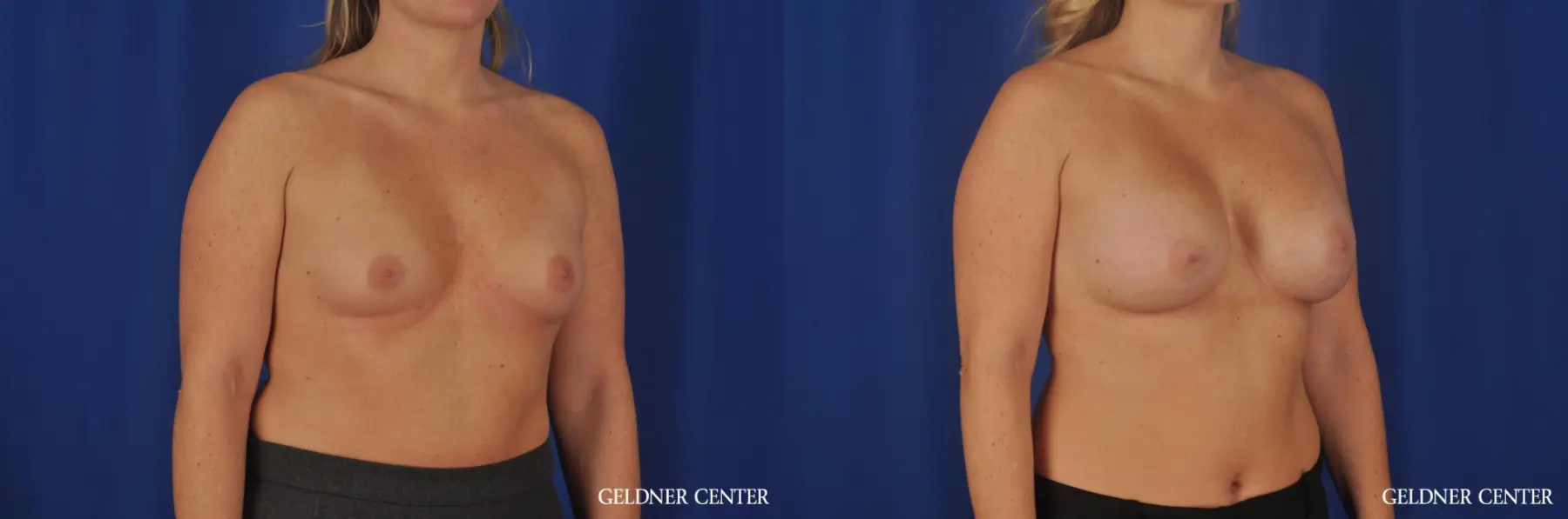 Breast Augmentation: Patient 185 - Before and After 2