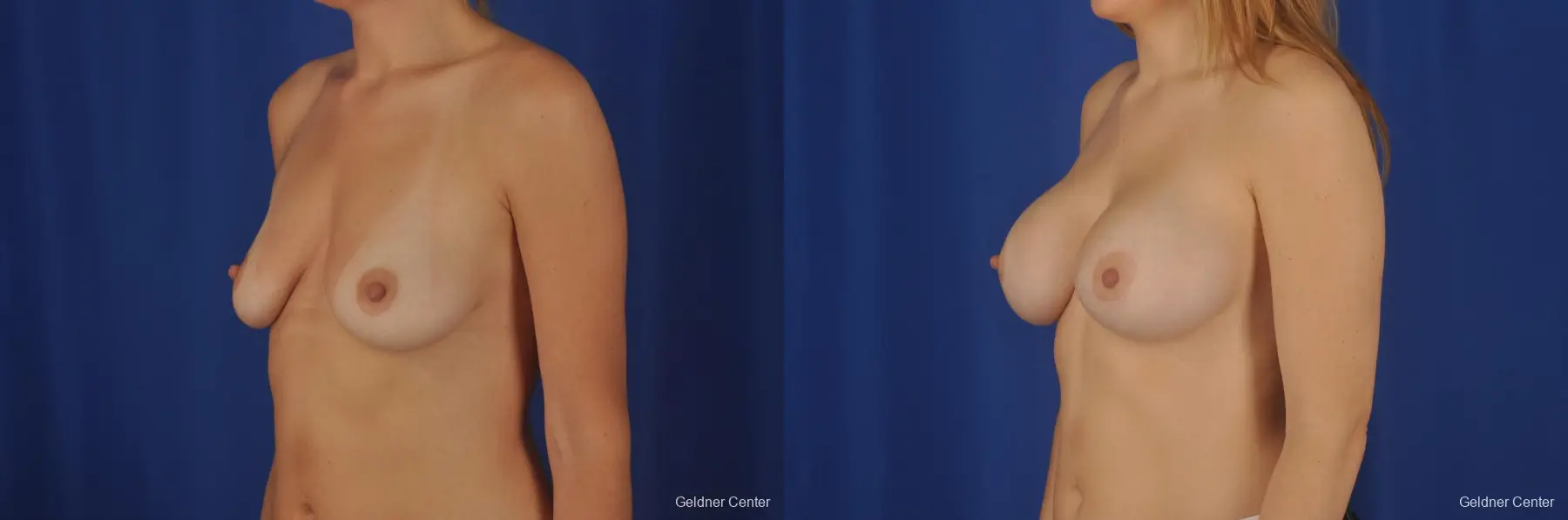 Chicago Breast Augmentation 2374 - Before and After 4