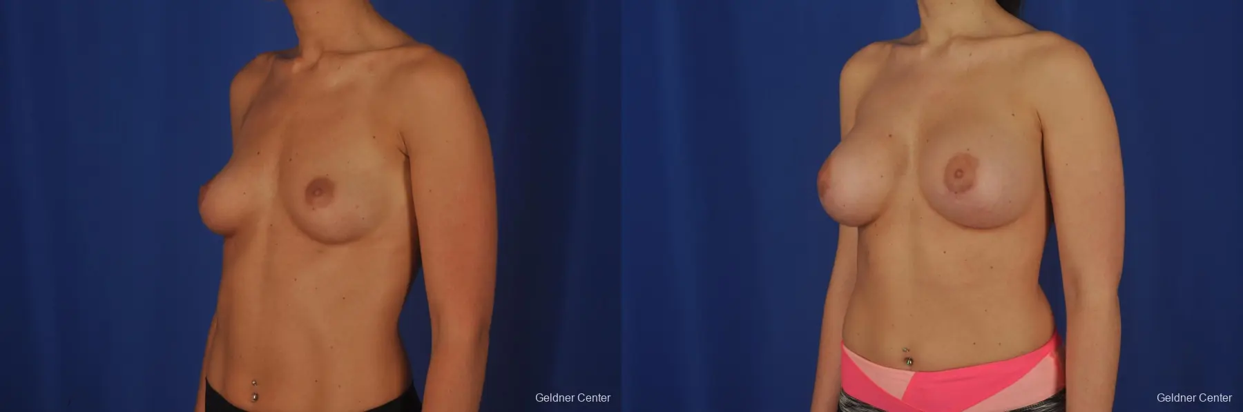 Breast Augmentation Lake Shore Dr, Chicago 2380 - Before and After 4