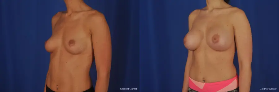 Breast Augmentation Lake Shore Dr, Chicago 2380 - Before and After 4