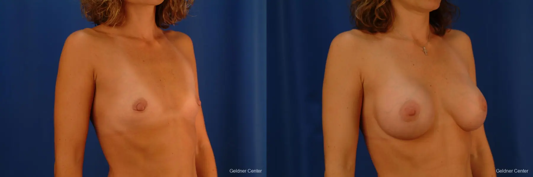 Chicago Breast Augmentation 2442 - Before and After 3