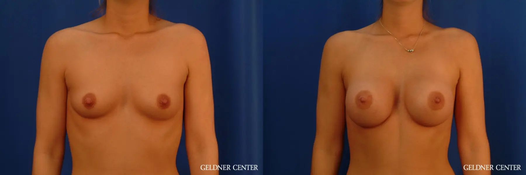 Breast Augmentation: Patient 182 - Before and After 1
