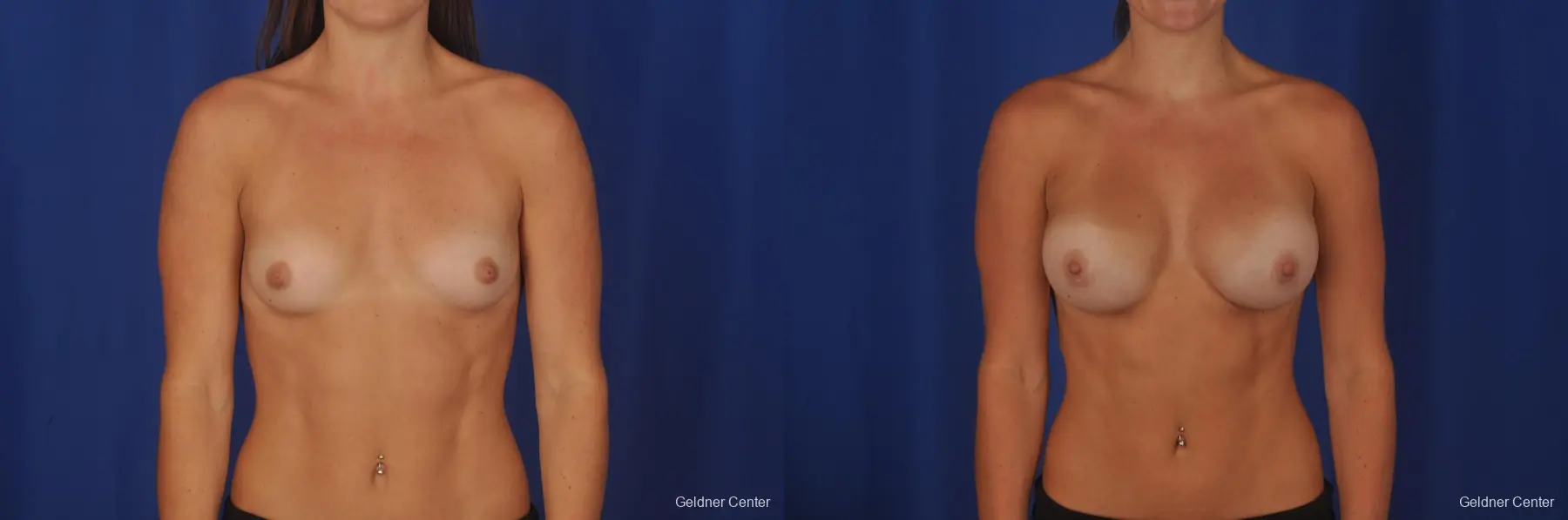 Chicago Breast Augmentation 2393 - Before and After 1
