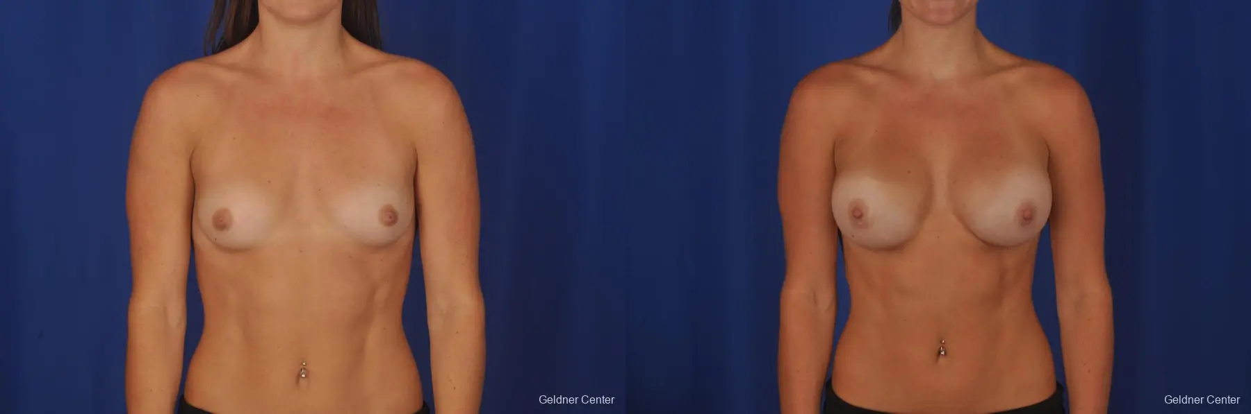 Chicago Breast Augmentation 2393 - Before and After