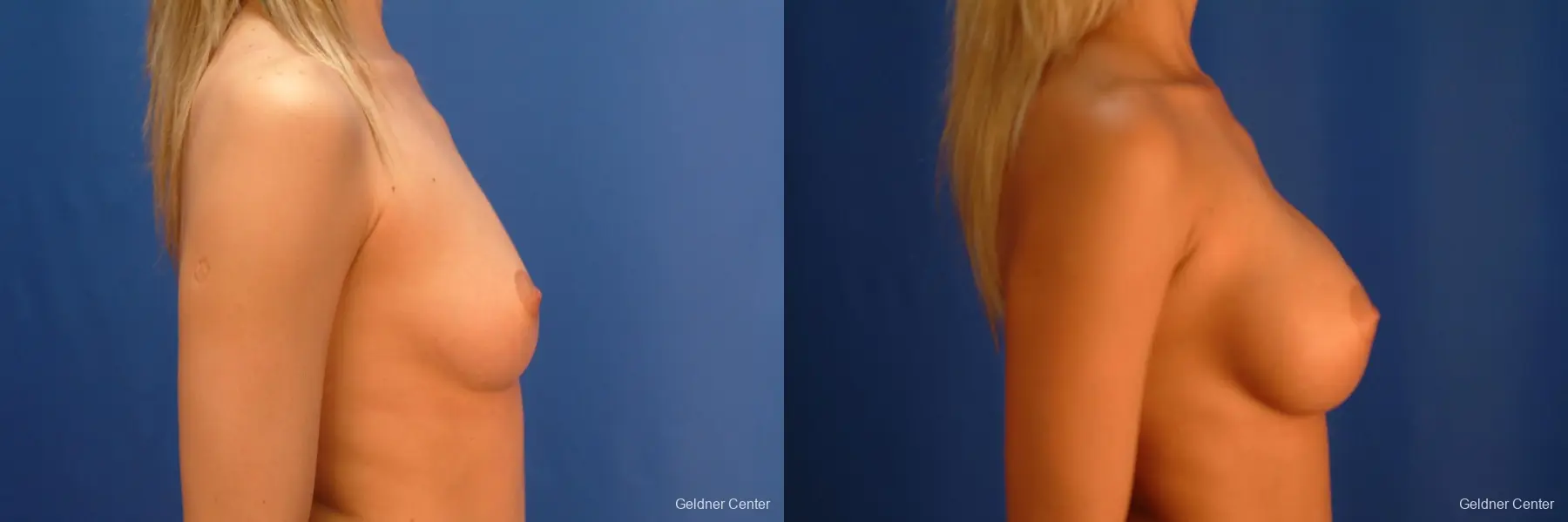 Chicago Breast Augmentation 2523 - Before and After 2
