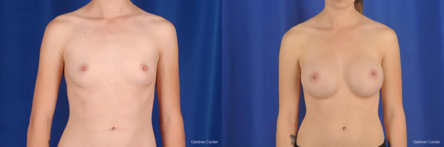 Chicago Breast Augmentation 2304 - Before and After 1