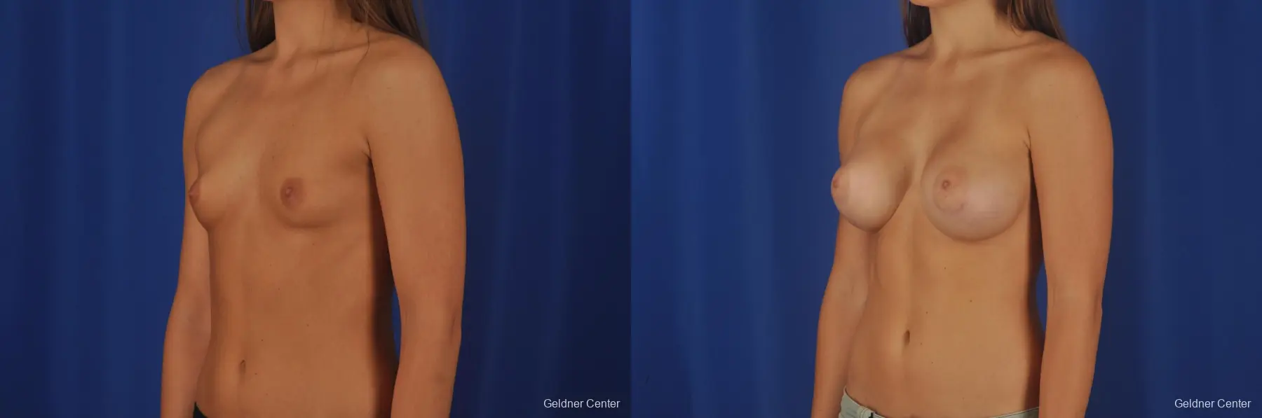 Breast Augmentation Streeterville, Chicago 3231 - Before and After 4