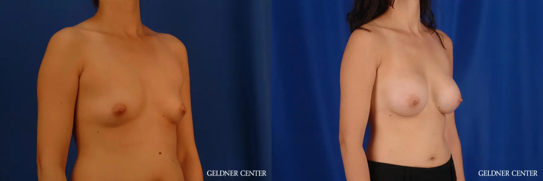 Breast Augmentation: Patient 178 - Before and After 2