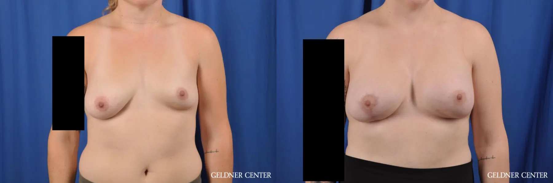 Breast Augmentation: Patient 179 - Before and After 1