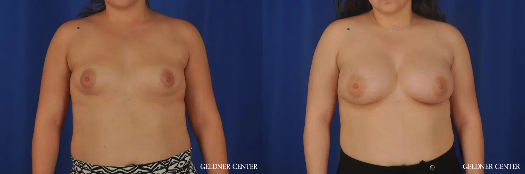 Breast Augmentation Hinsdale, Chicago 5466 - Before and After