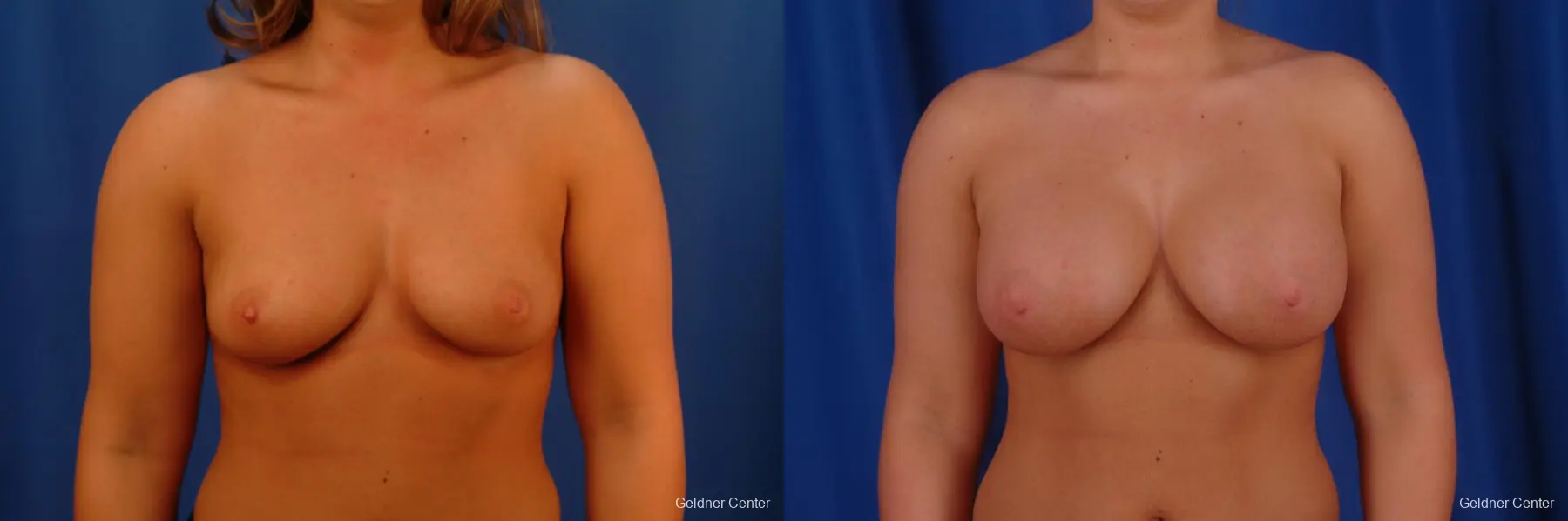 Chicago Breast Augmentation 2633 - Before and After