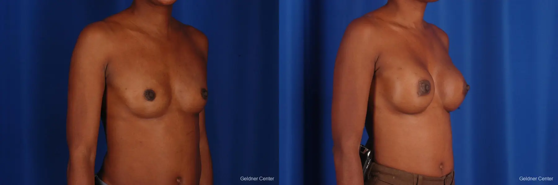 Chicago Breast Augmentation 2293 - Before and After 3