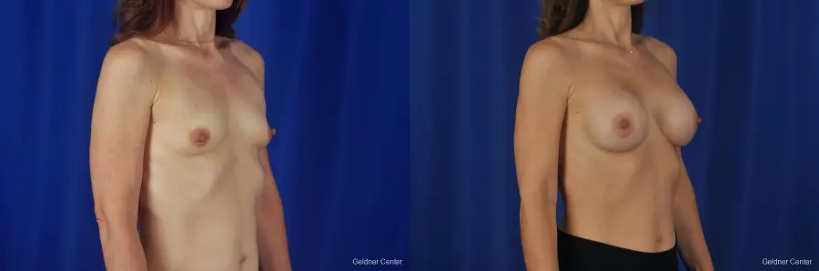 Chicago Breast Augmentation Natrelle Smooth Gel Implants 2067 - Before and After 3