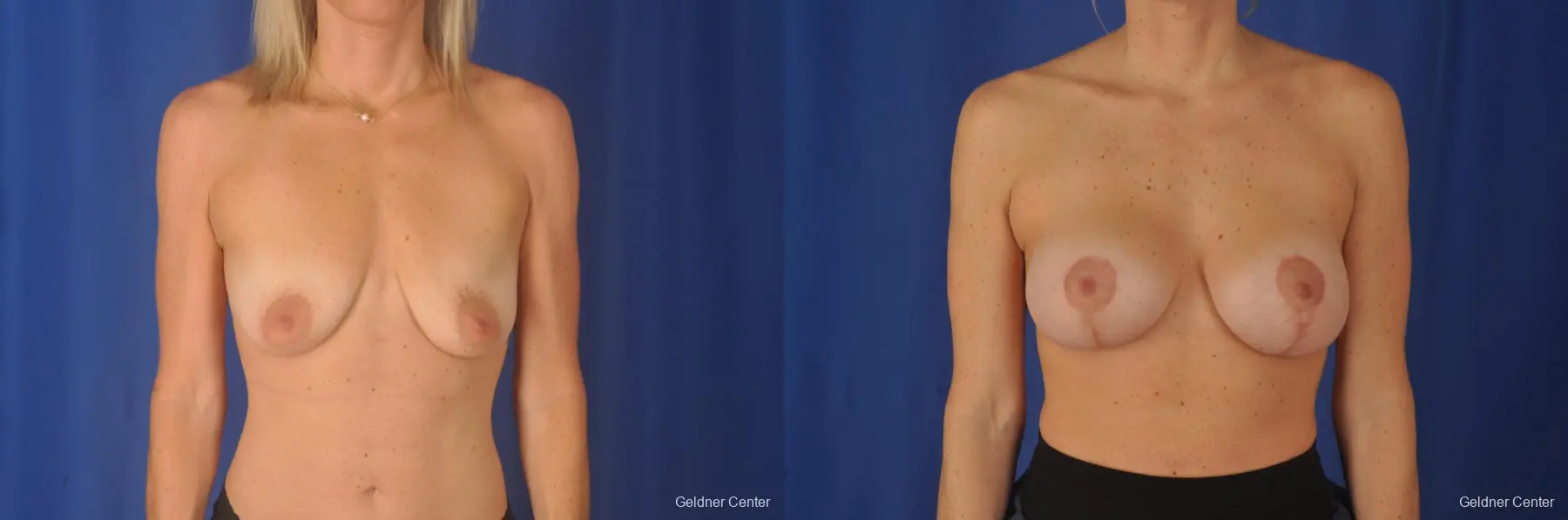 Breast Augmentation: Patient 80 - Before and After 1