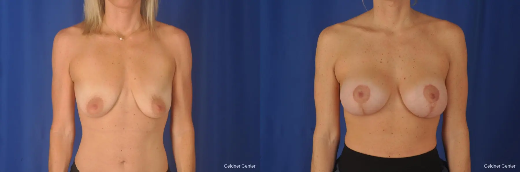 Vertical Mastopexy with Subpectoral Biplanar Breast Augmentation - Before and After