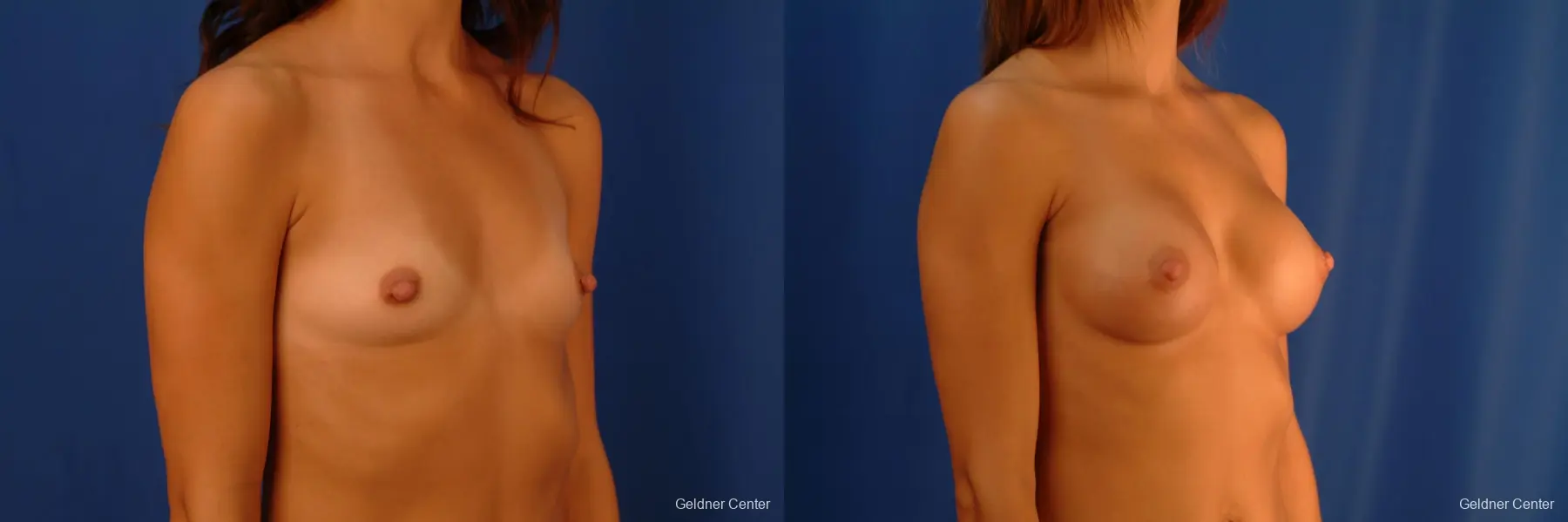 Breast Augmentation Hinsdale, Chicago 2412 - Before and After 3