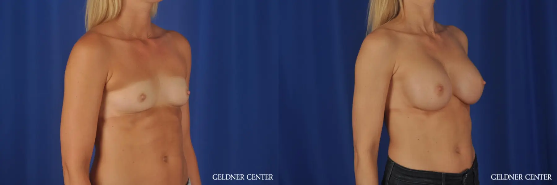 Breast Augmentation: Patient 169 - Before and After 2