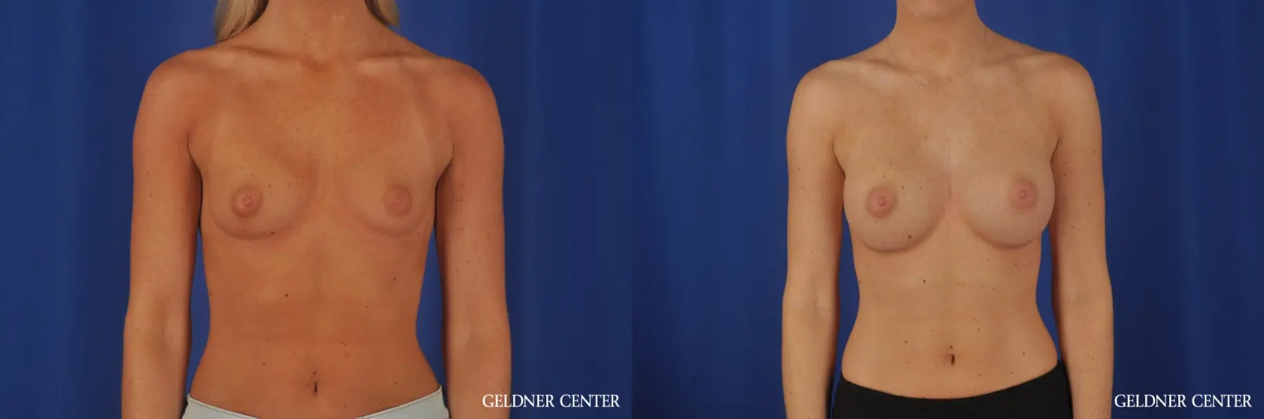 Chicago Breast Augmentation 4292 - Before and After