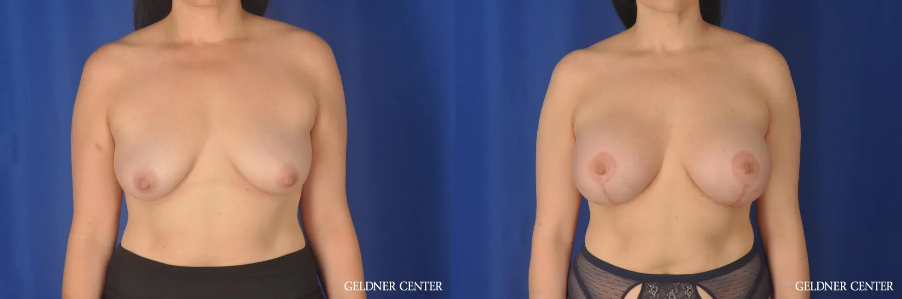 Chicago Breast Augmentation 11856 - Before and After