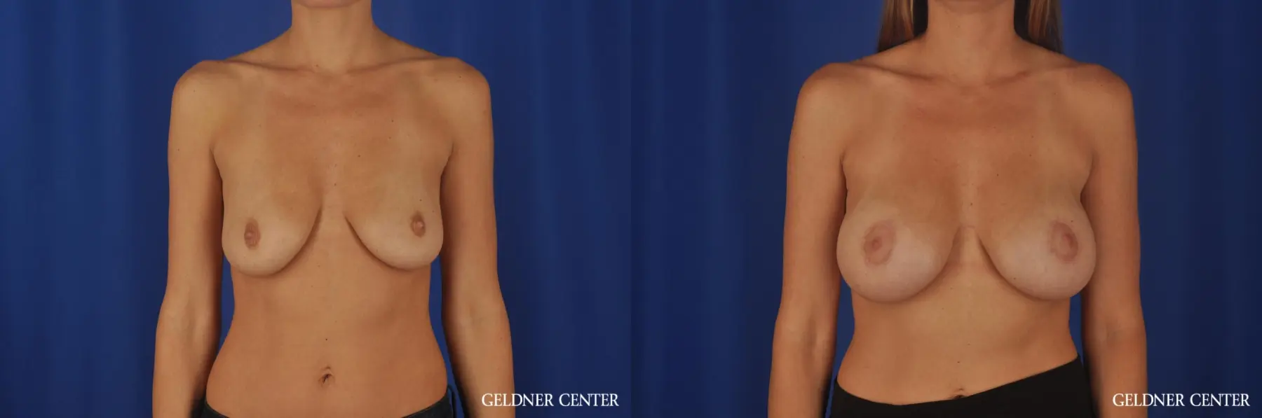 Chicago Breast Augmentation 5476 - Before and After