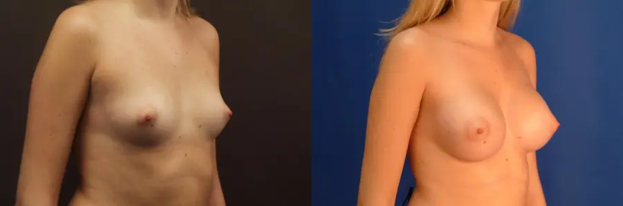 Chicago Breast Augmentation 2545 - Before and After 2