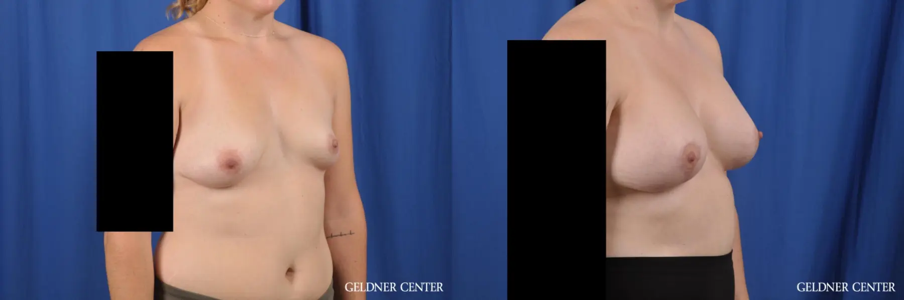 Breast Augmentation: Patient 179 - Before and After 2