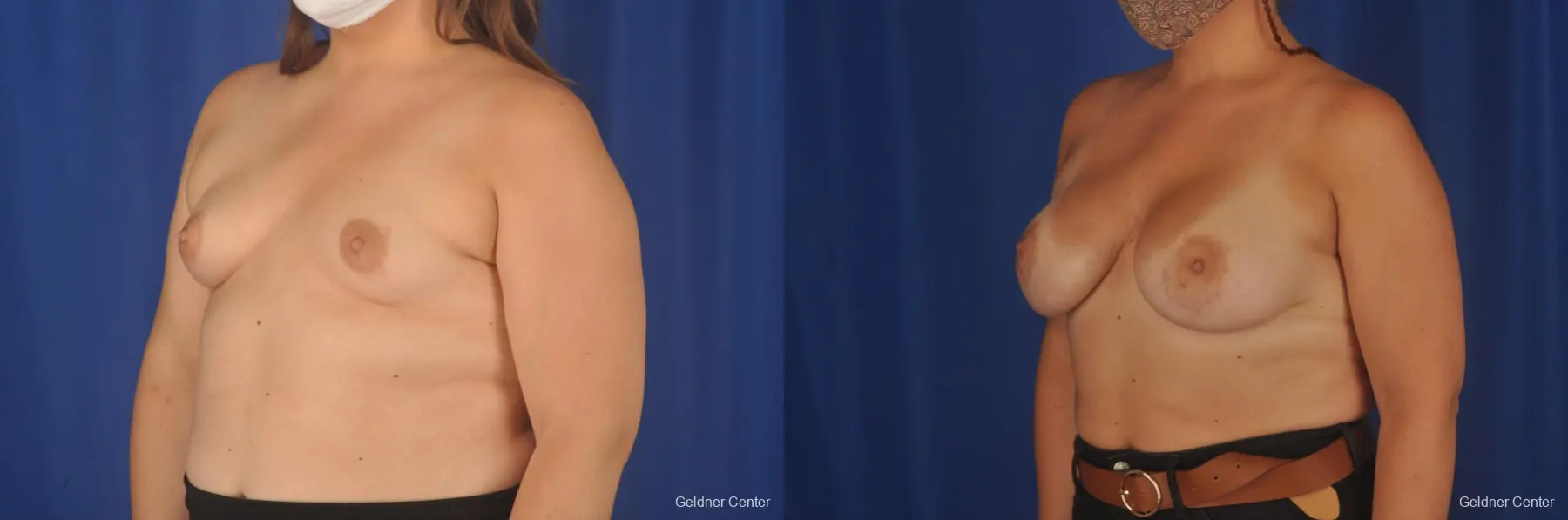 Breast Augmentation: Patient 190 - Before and After 5