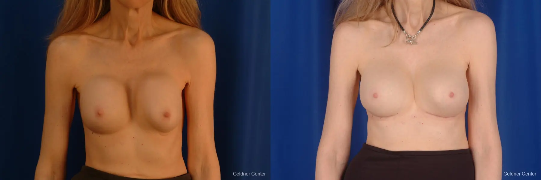 Chicago Breast Augmentation 2397 - Before and After 1