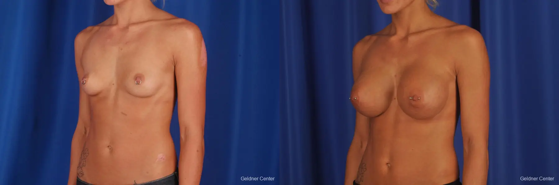 Chicago Breast Augmentation 2328 - Before and After 4