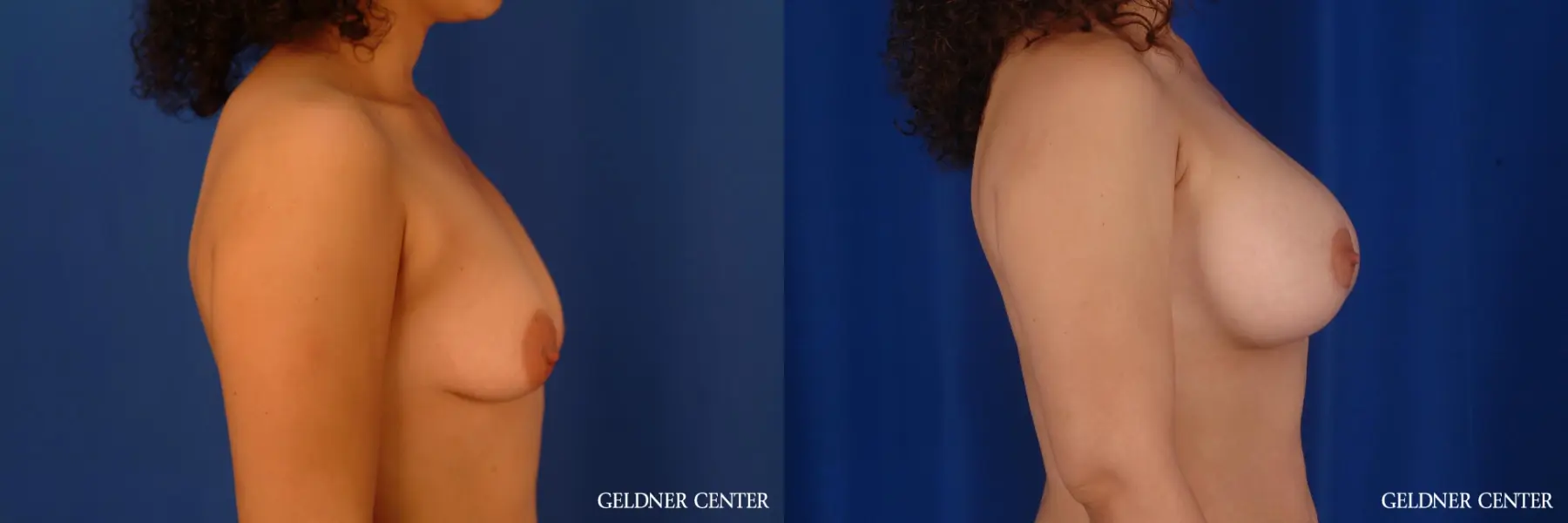 Breast Augmentation: Patient 161 - Before and After 3