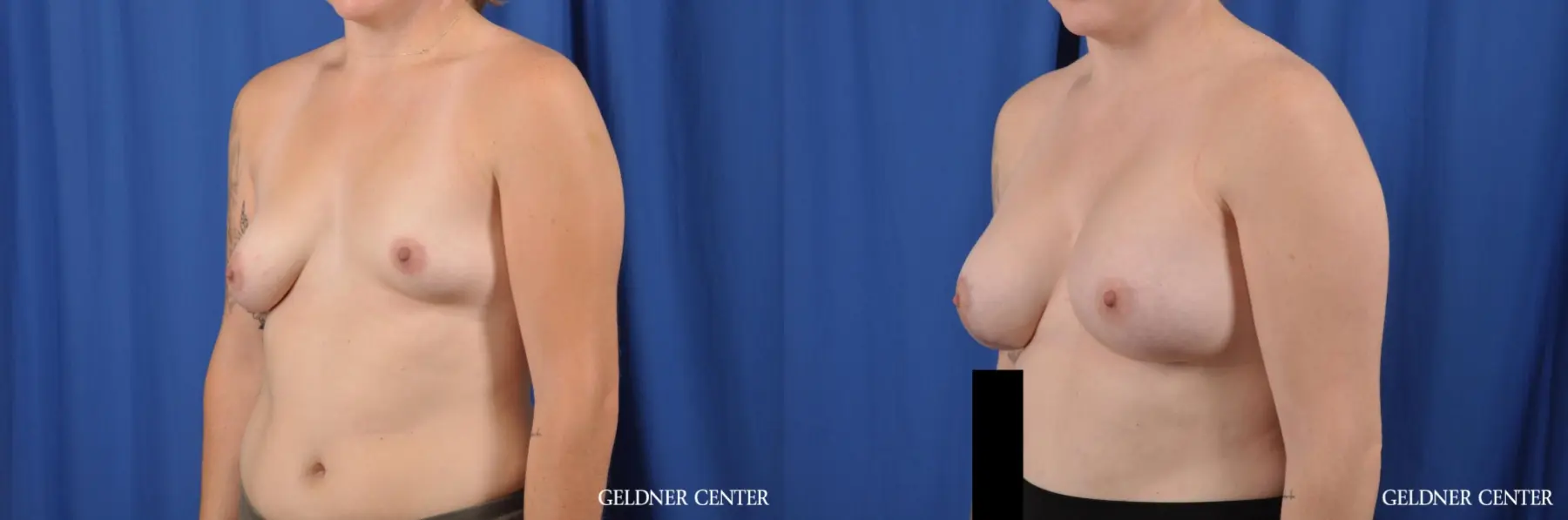 Breast Augmentation: Patient 179 - Before and After 4