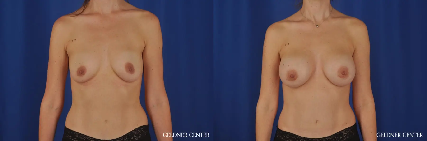 Chicago Breast Augmentation 4002 - Before and After