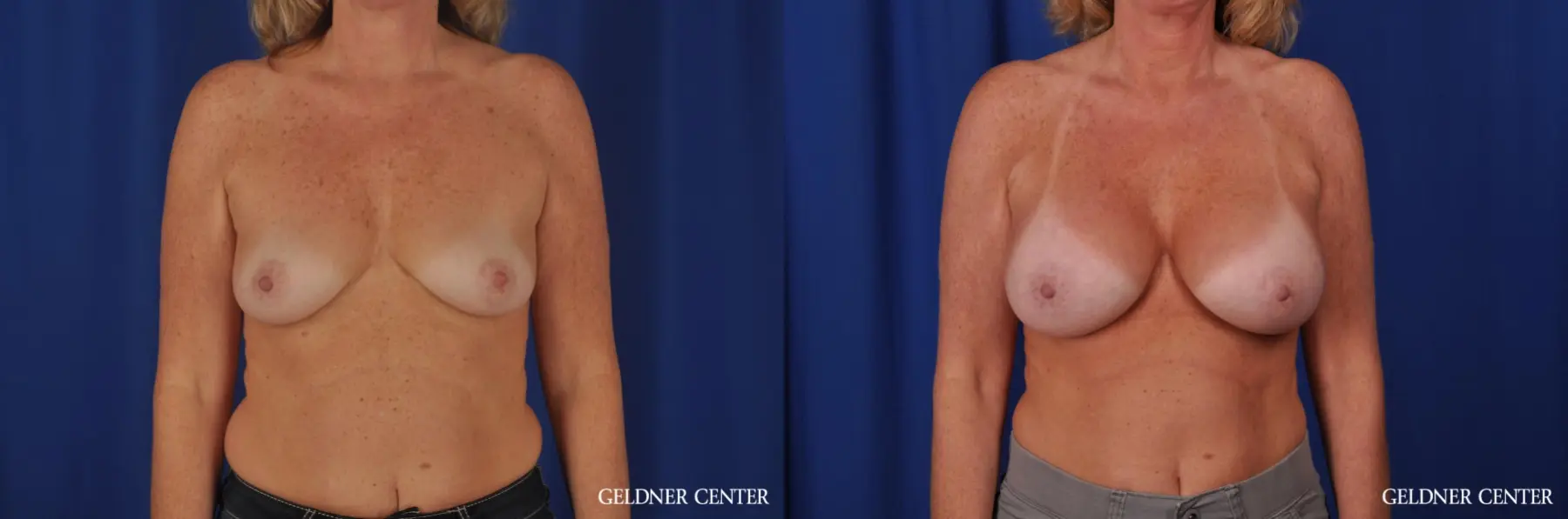 Breast Augmentation: Patient 166 - Before and After 1
