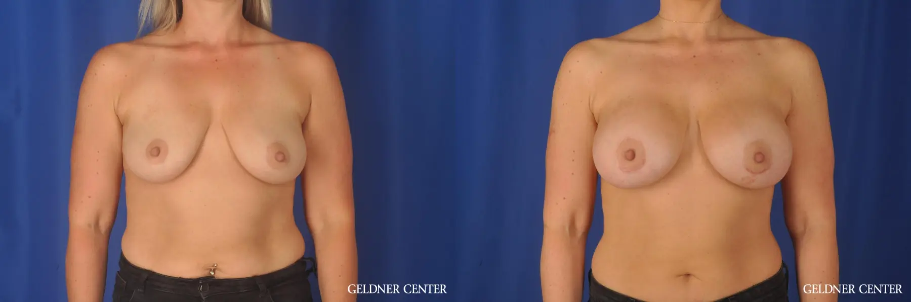 Breast Augmentation Biplanar subpectoral 400cc - Before and After