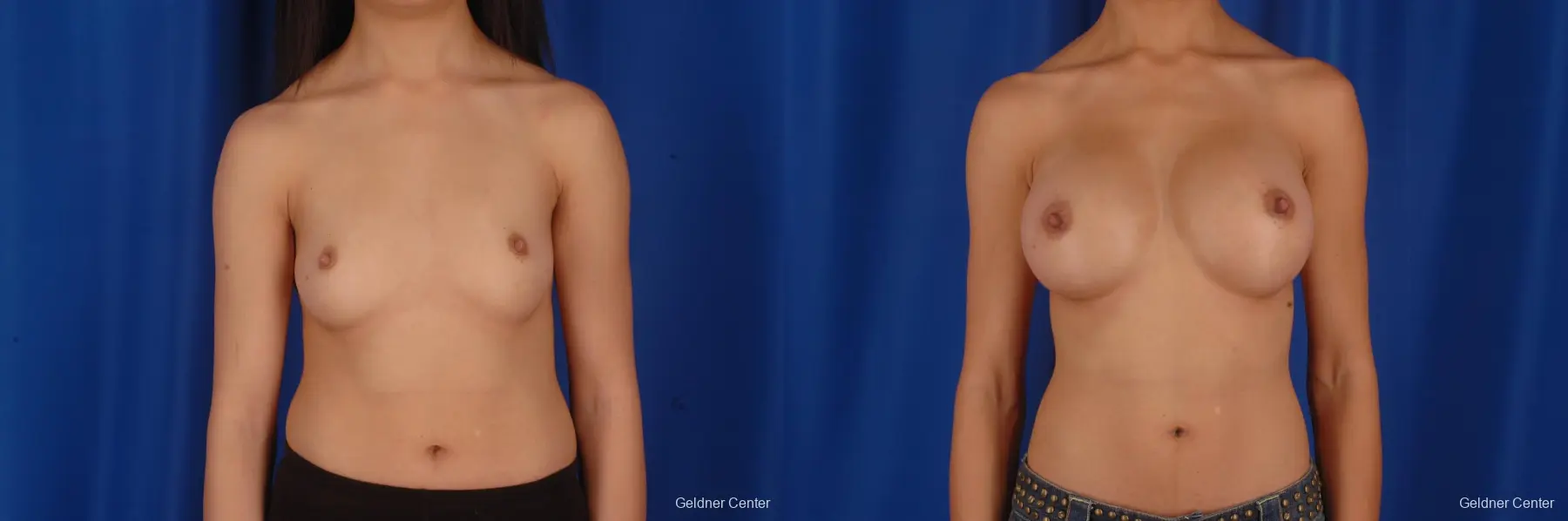 Chicago Breast Augmentation 2339 - Before and After 1