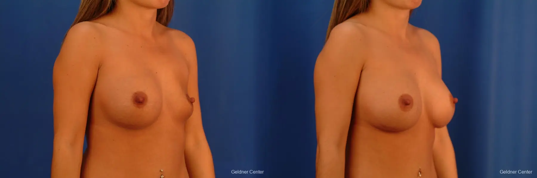 Chicago Breast Augmentation 2526 - Before and After 2