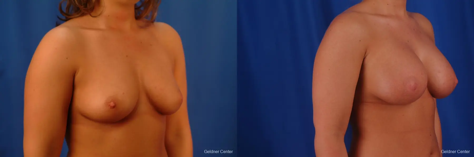 Chicago Breast Augmentation 2633 - Before and After 3