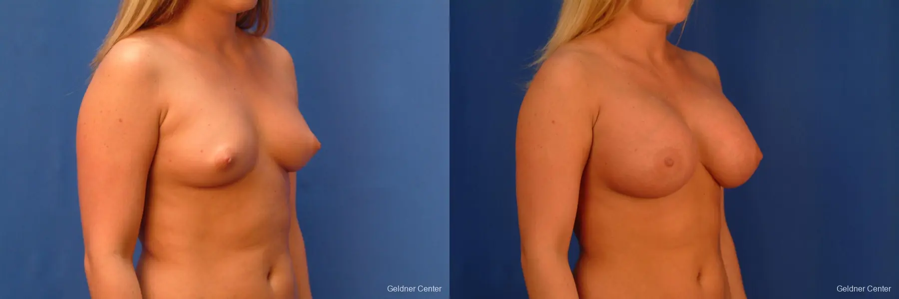 Chicago Breast Augmentation 2443 - Before and After 3