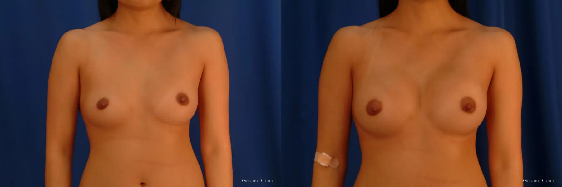 Underarm Breast Augmentation Streeterville, Chicago 2621 - Before and After 1