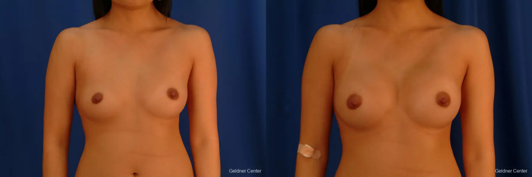 Underarm Breast Augmentation 300cc - Before and After