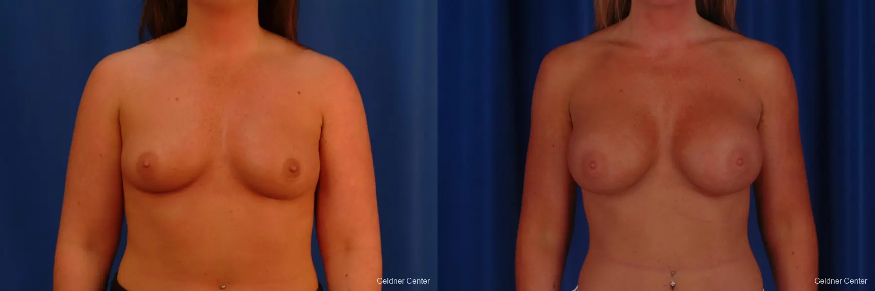 Chicago Breast Augmentation 2636 - Before and After