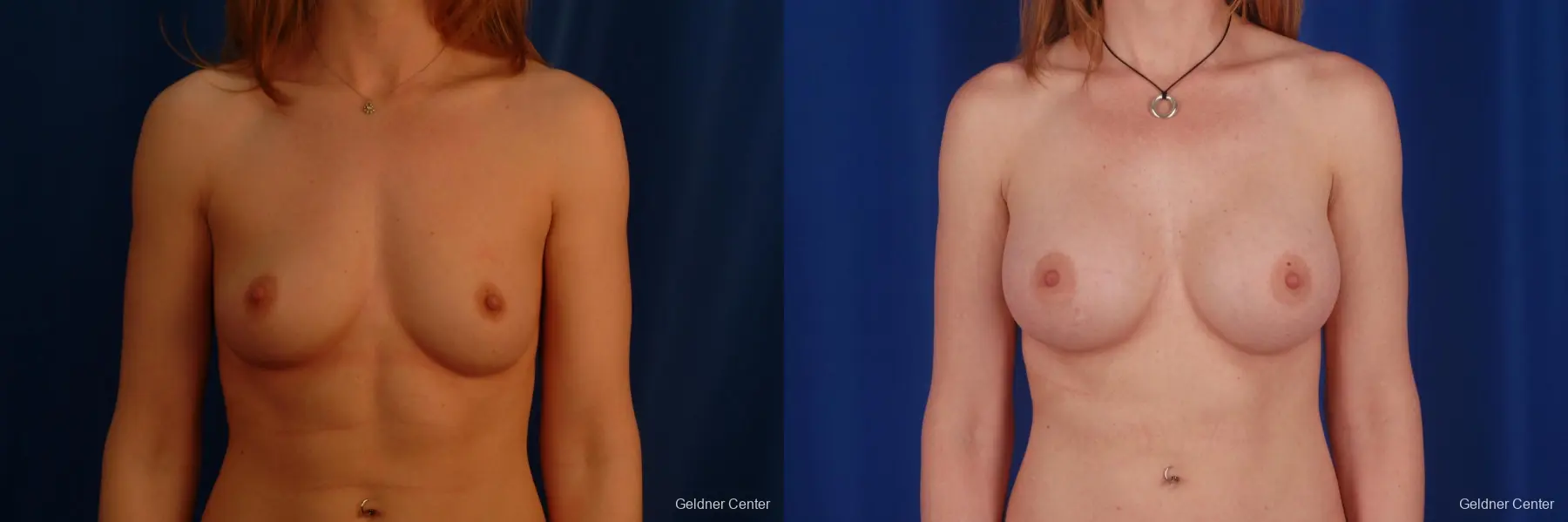 Chicago Breast Augmentation 2634 - Before and After 1